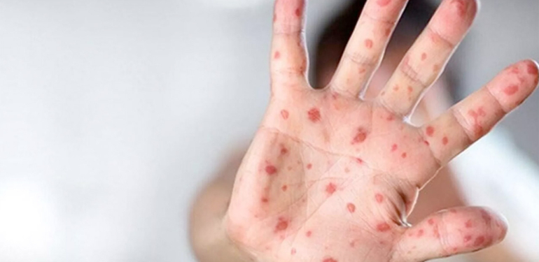 İletişim Başkanlığı, ‘maymun çiçeği’ hastalığına ilişkin merak edilen soru ve yanıtları yayımladı